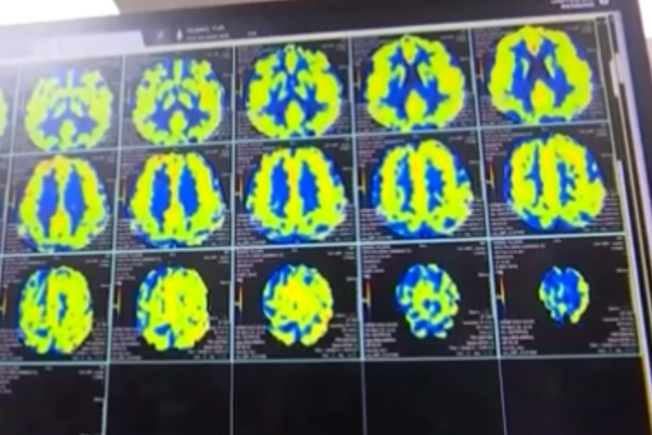 Dünyanın ilk invaziv BCI cihazına Çin'den onay<